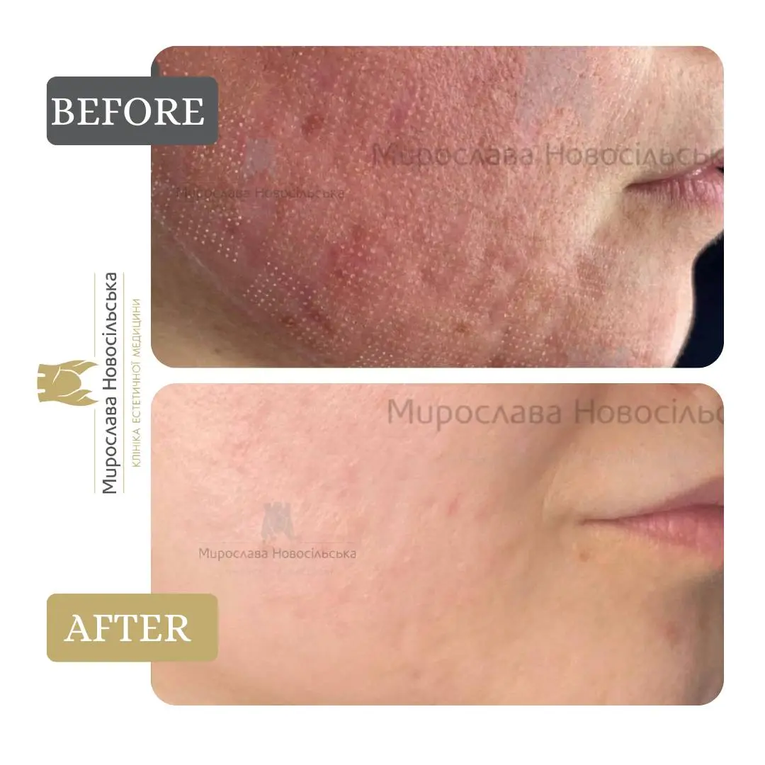 Laser resurfacing of scars and post acne