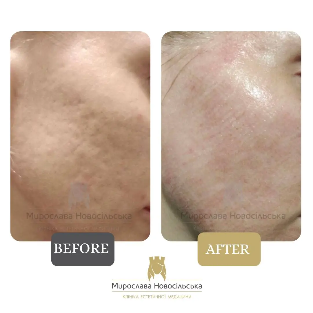 Laser resurfacing of scars and post acne, photo 7
