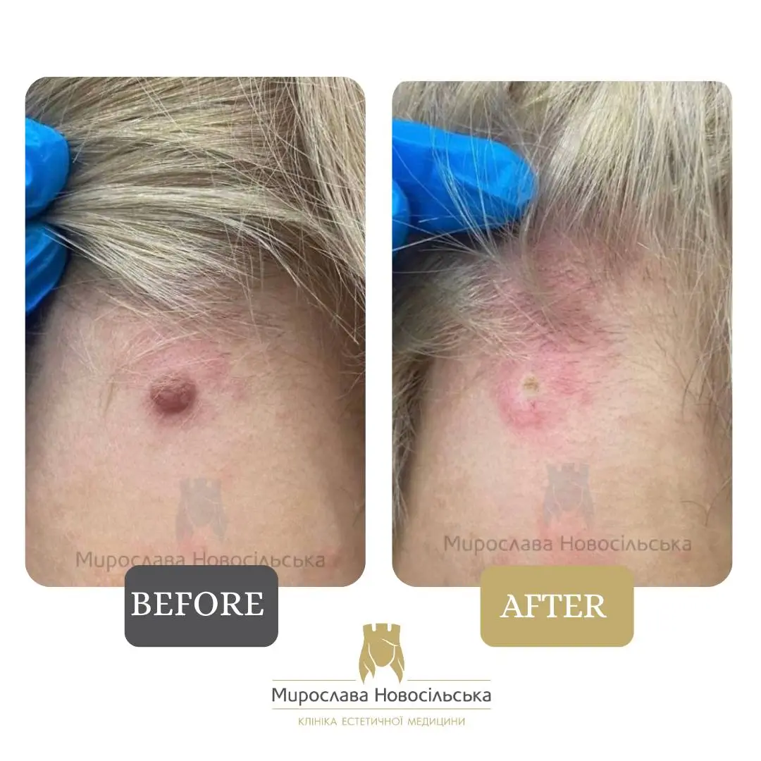 Laser mole removal