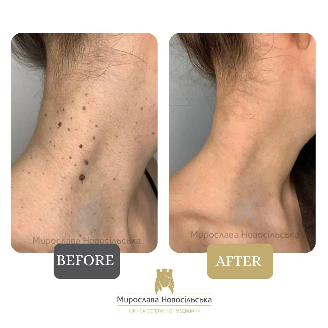 Laser mole removal