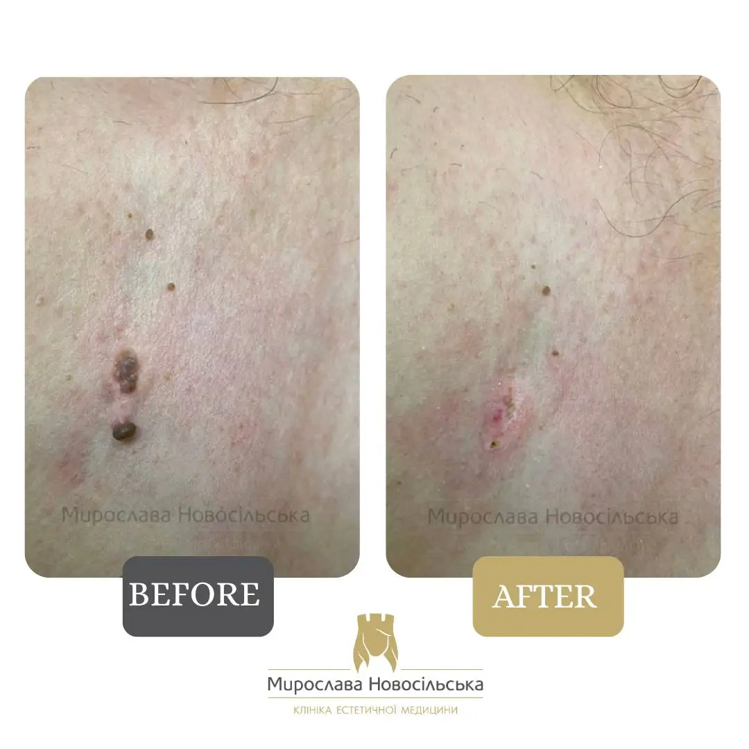 Laser mole removal