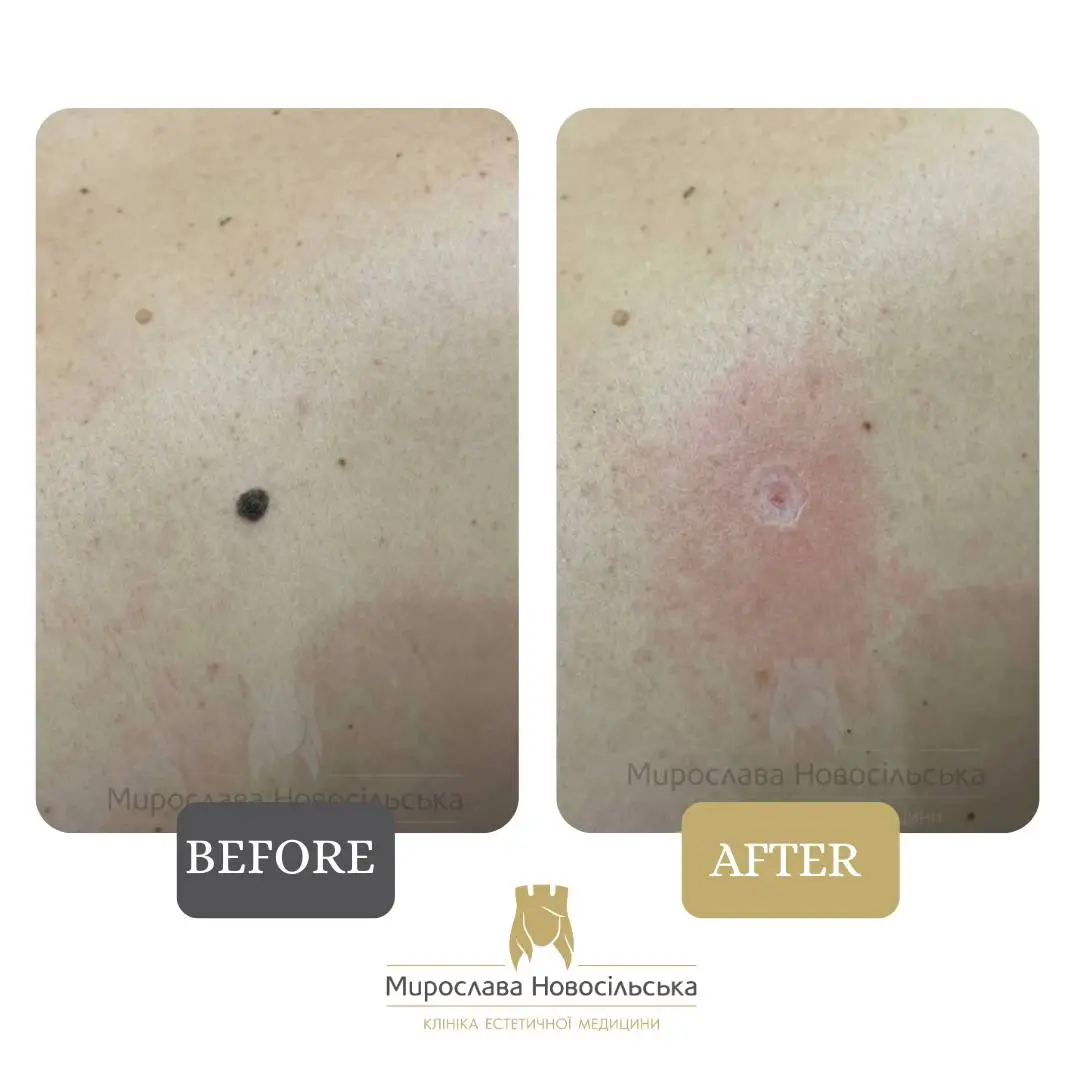 Laser mole removal