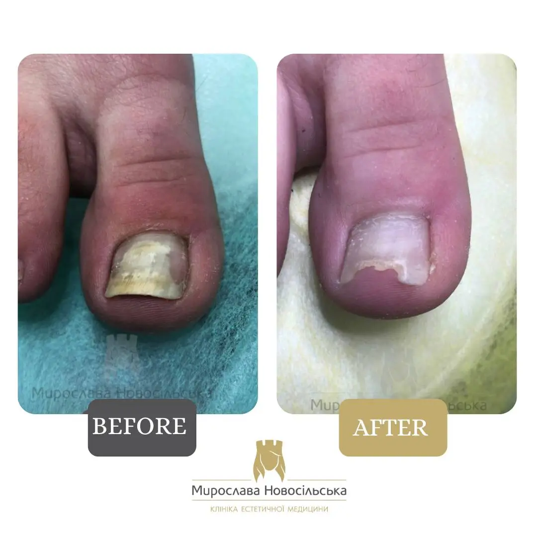 Fungus laser treatment, photo 2