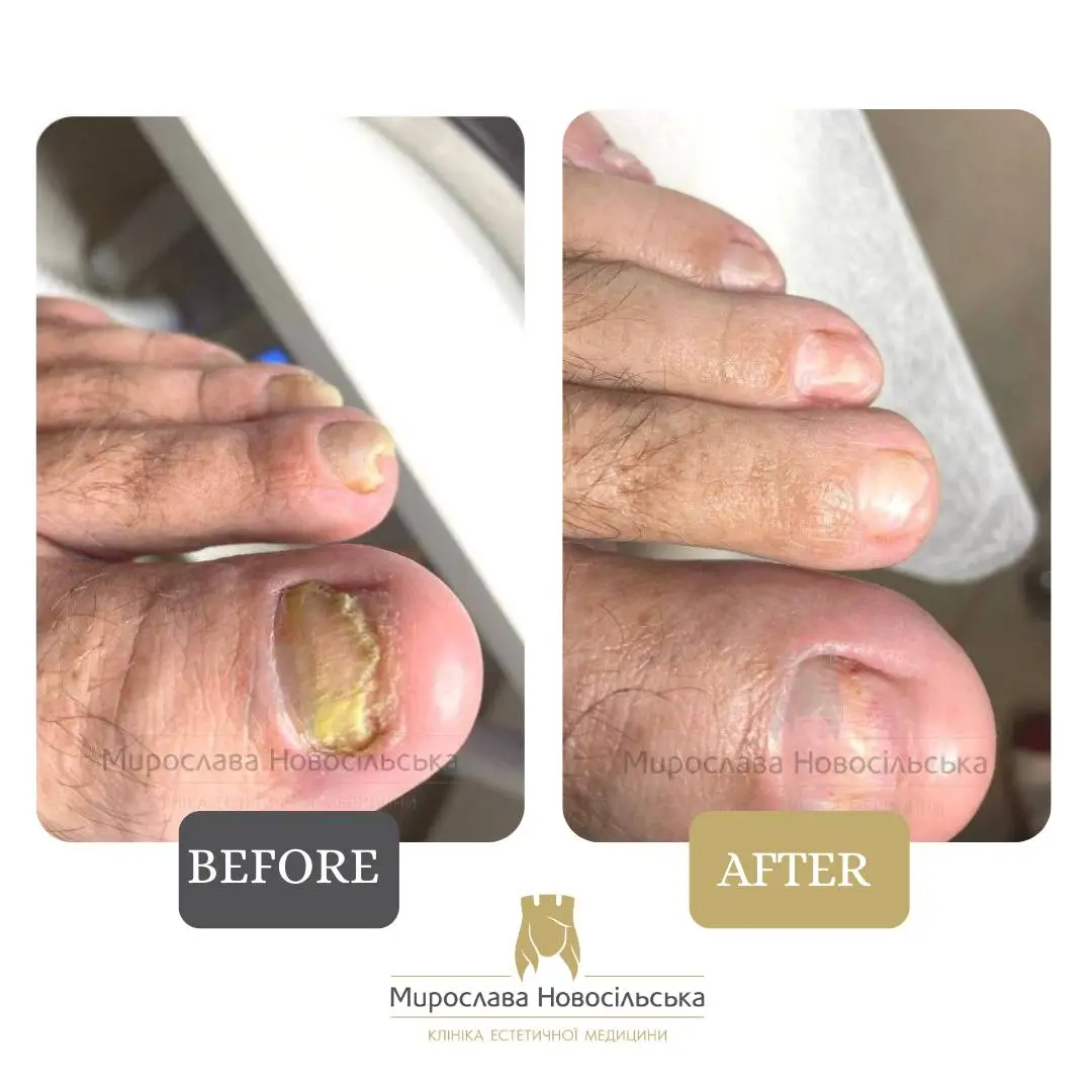 Fungus laser treatment