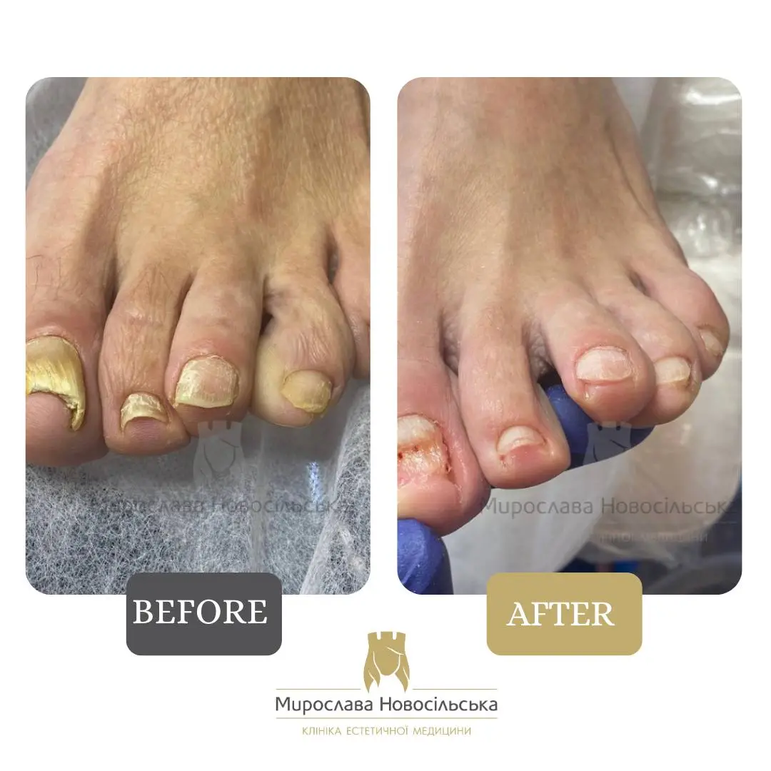 Fungus laser treatment