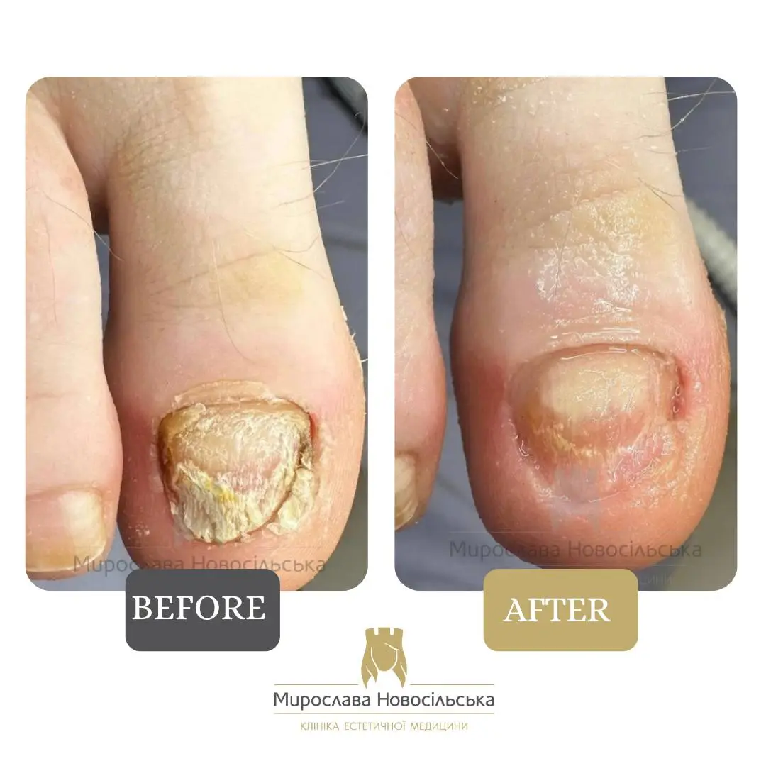 Fungus laser treatment, photo 5