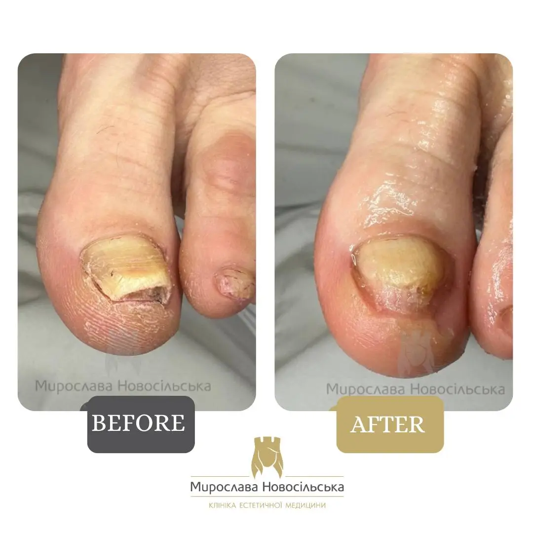 Fungus laser treatment, photo 6