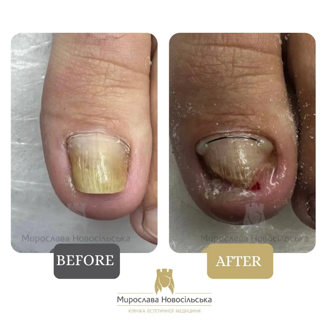 Fungus laser treatment, photo 7