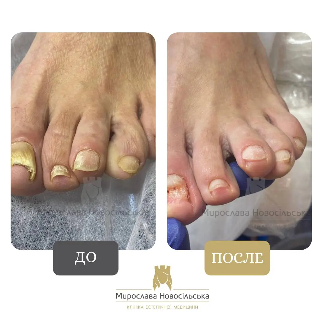 Лазерное лечение грибка, фото 4