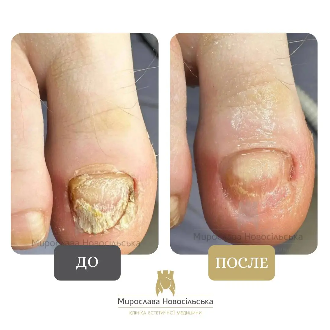 Лазерное лечение грибка, фото 5