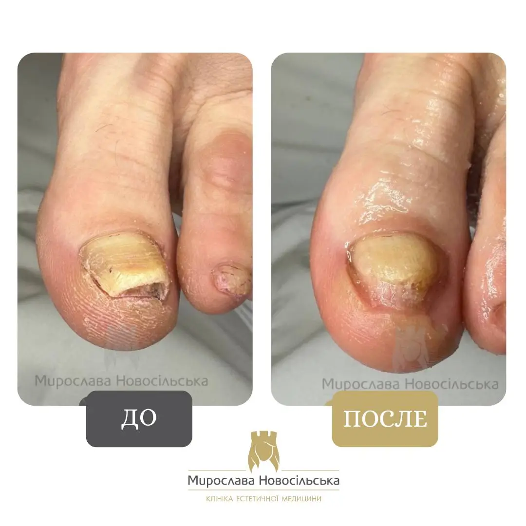Лазерное лечение грибка, фото 6