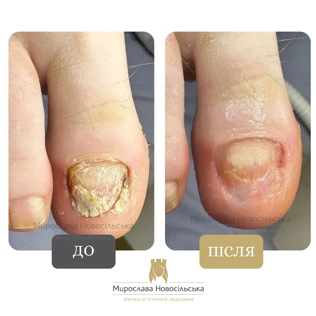 Лазерне лікування грибка, фото 5