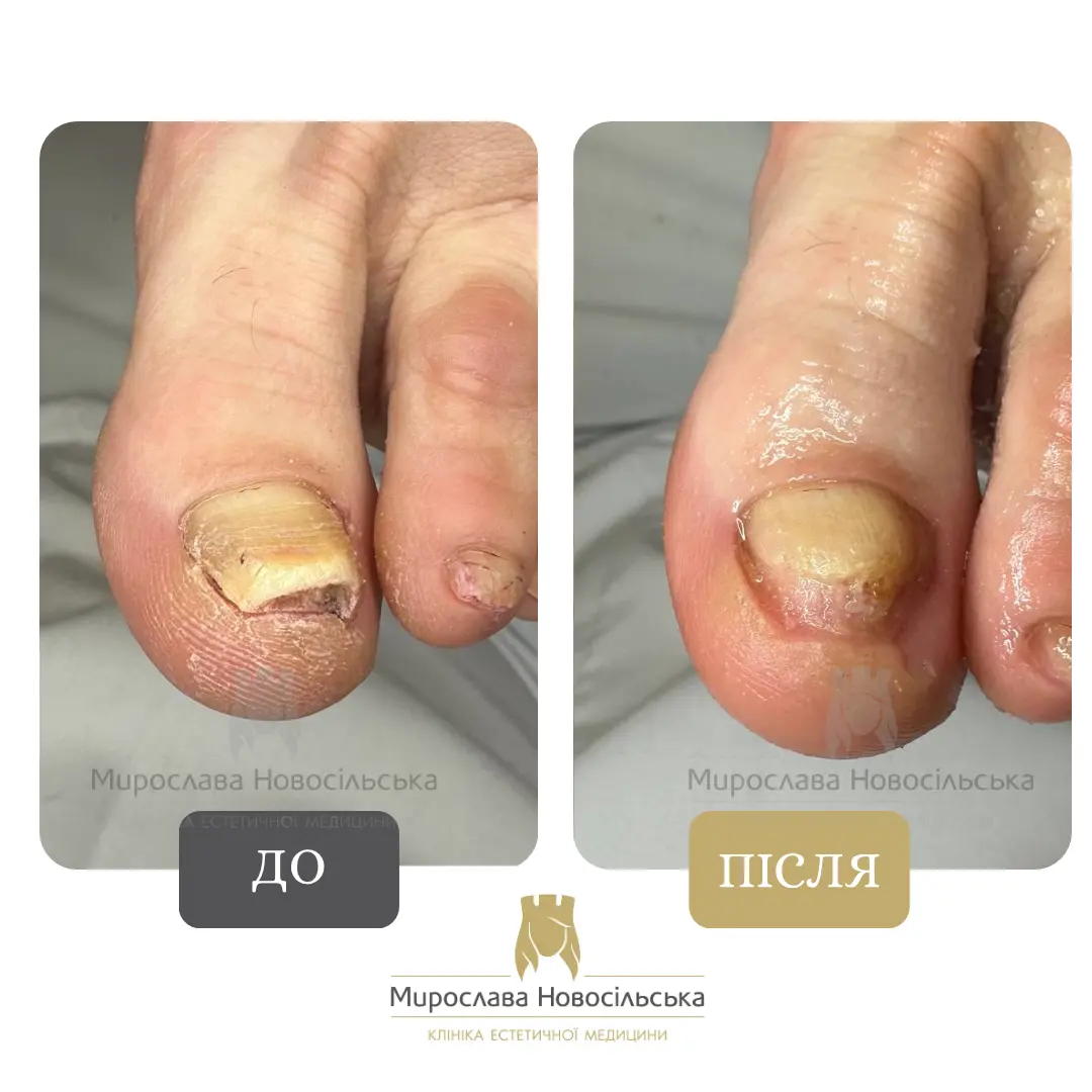 Лазерне лікування грибка, фото 6