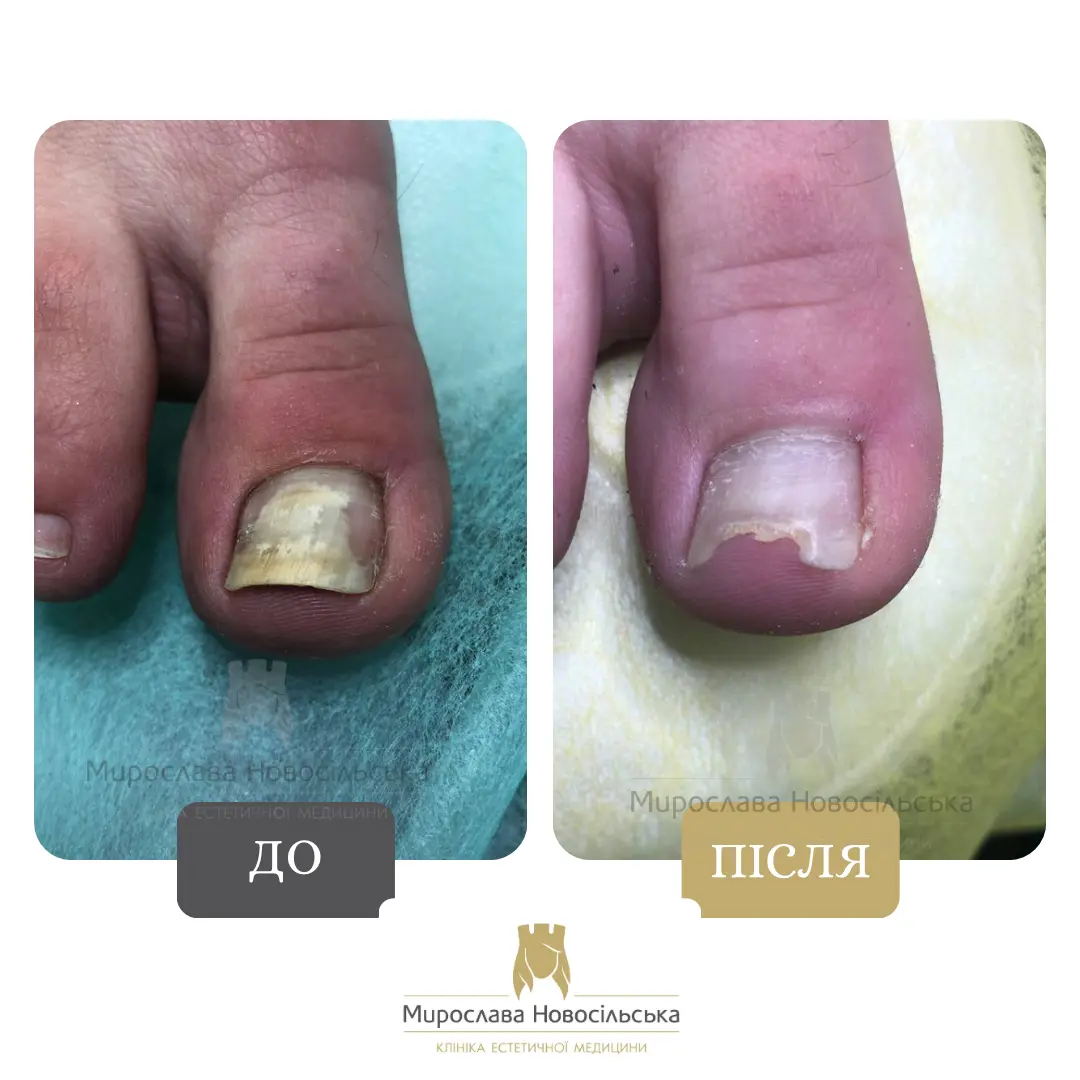 Лазерне лікування грибка, фото 2