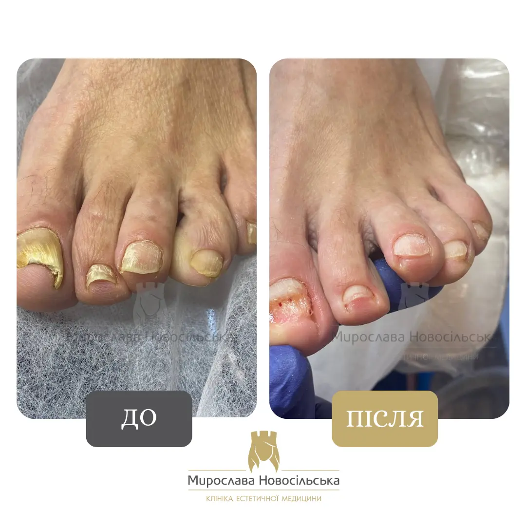 Лазерне лікування грибка, фото 4