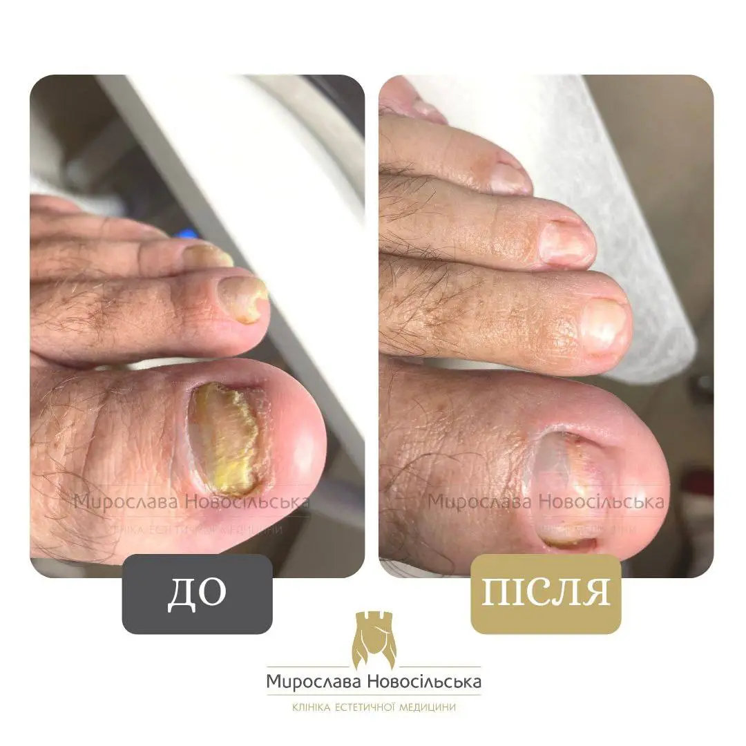 Лазерне лікування грибка, фото 3