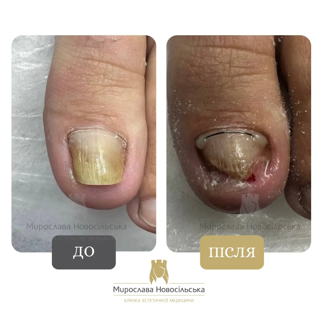 Лазерне лікування грибка, фото 7