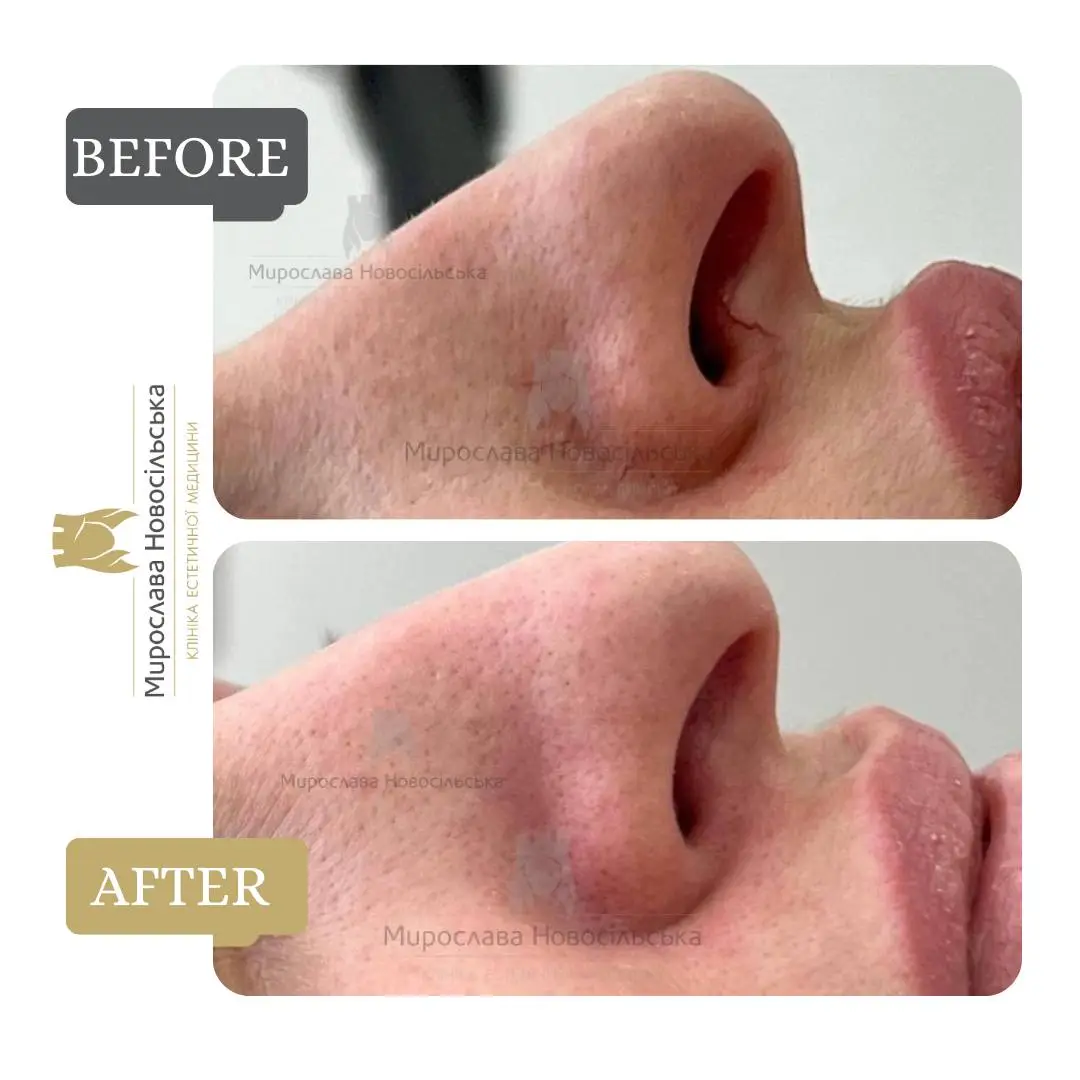 Laser removal of vascular lesions on the face