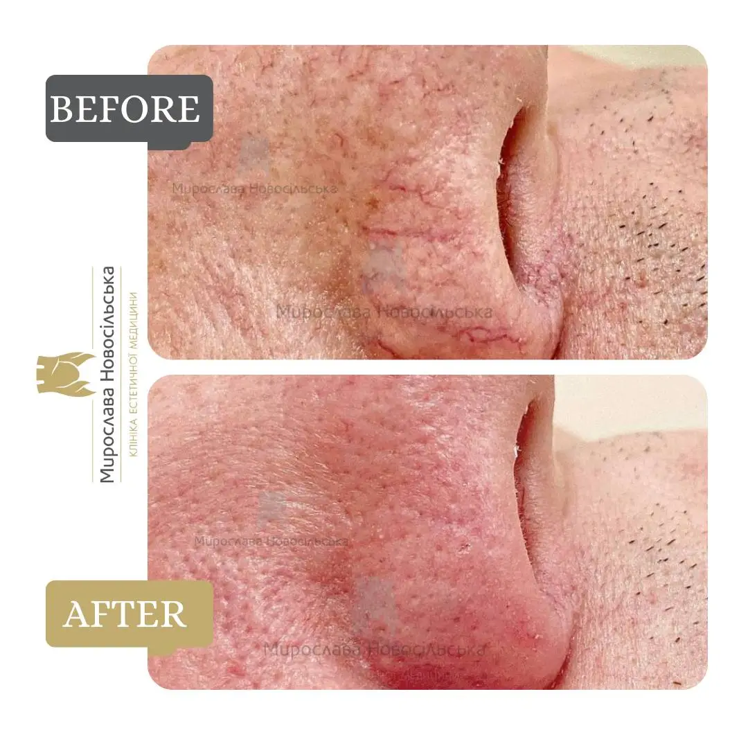 Laser removal of vascular lesions on the face, photo 4