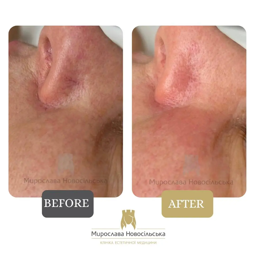 Laser removal of vascular lesions on the face