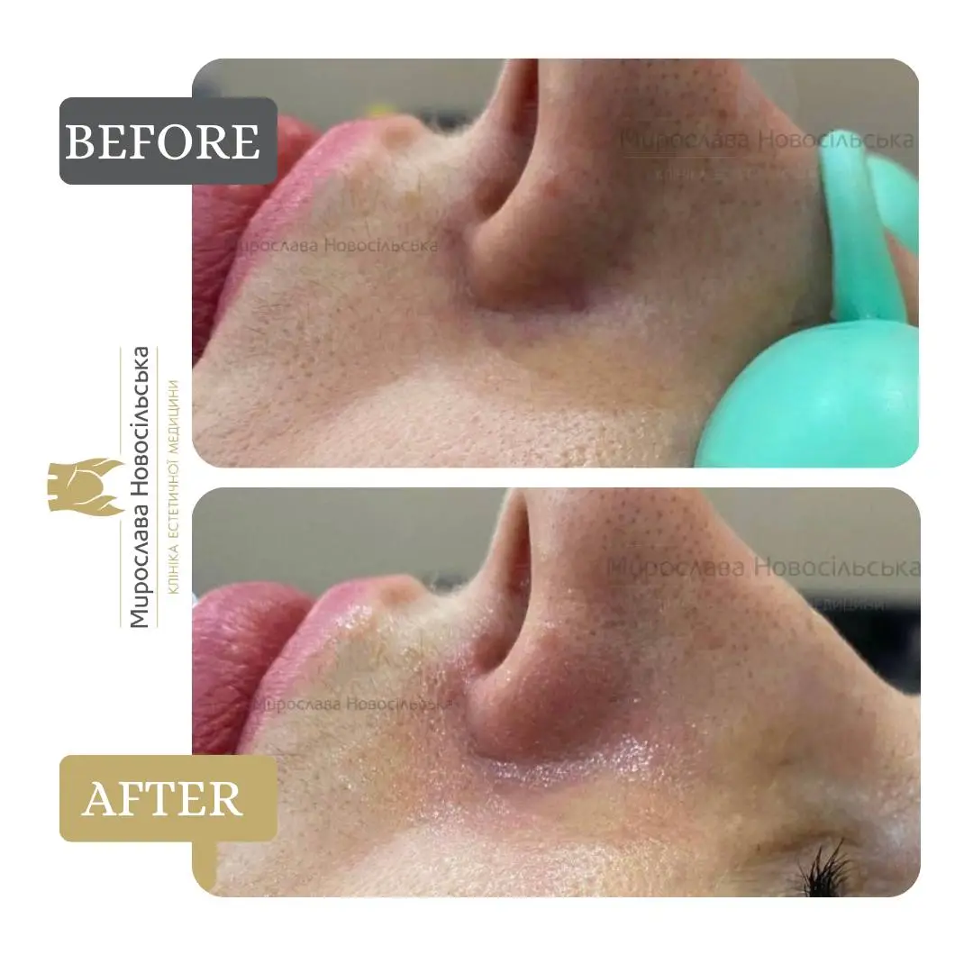 Laser removal of vascular lesions on the face