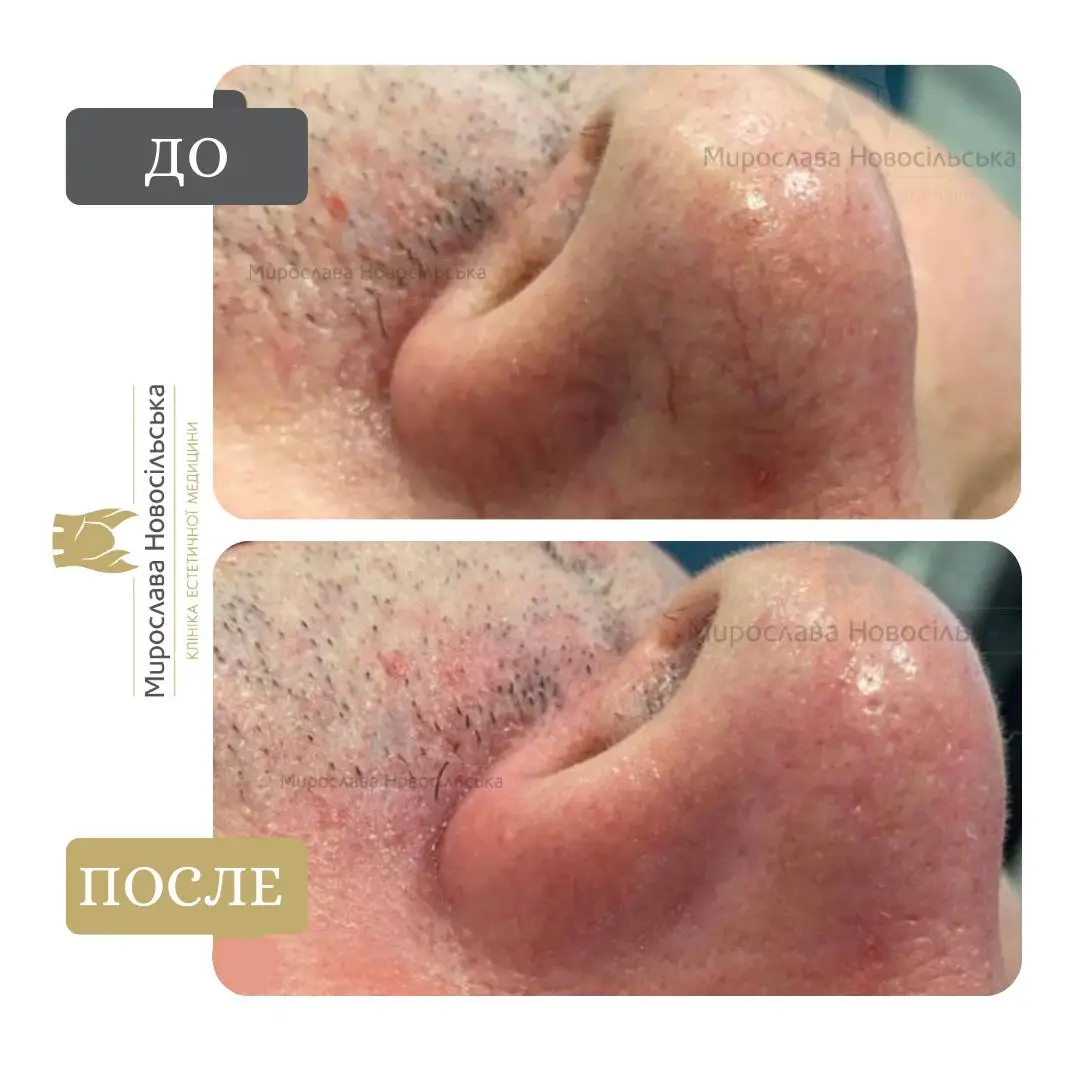 Лазерное удаление сосудов на лице, фото 5