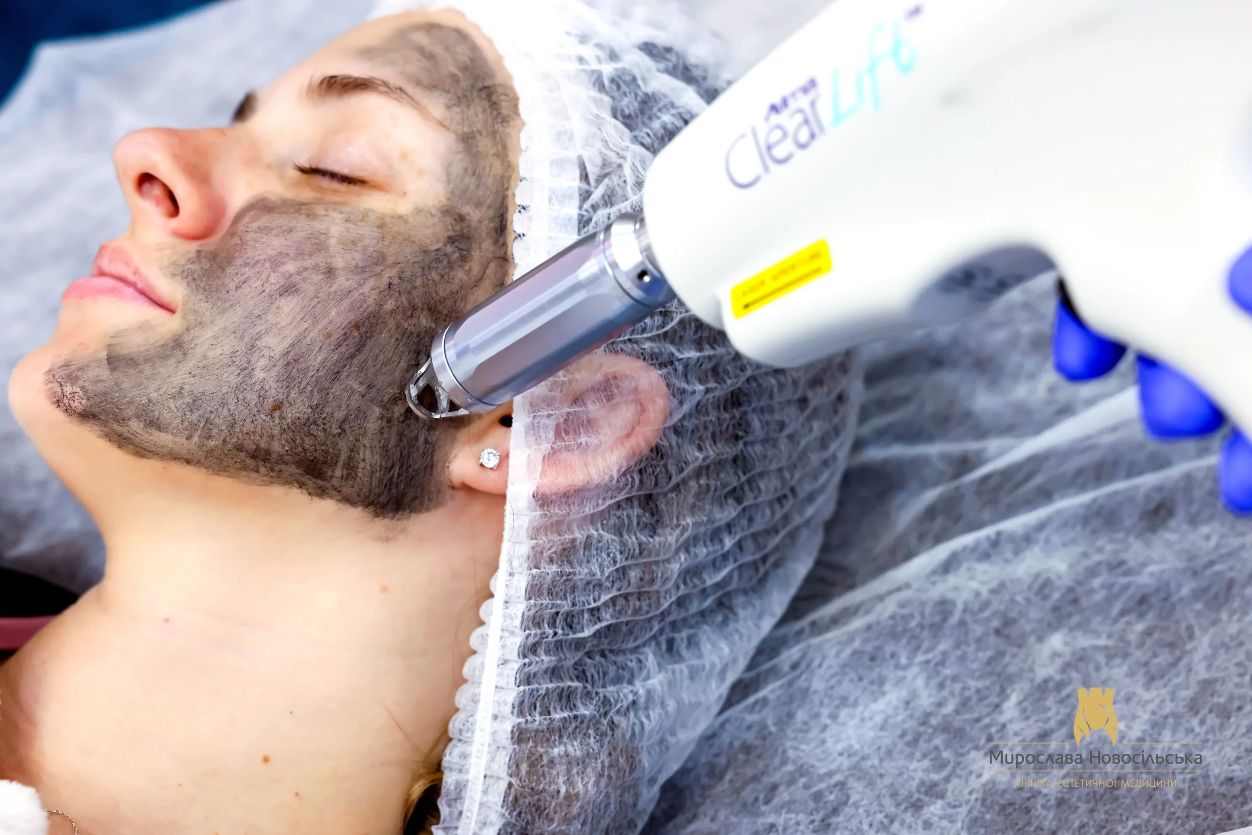 Facial peels, photo 1