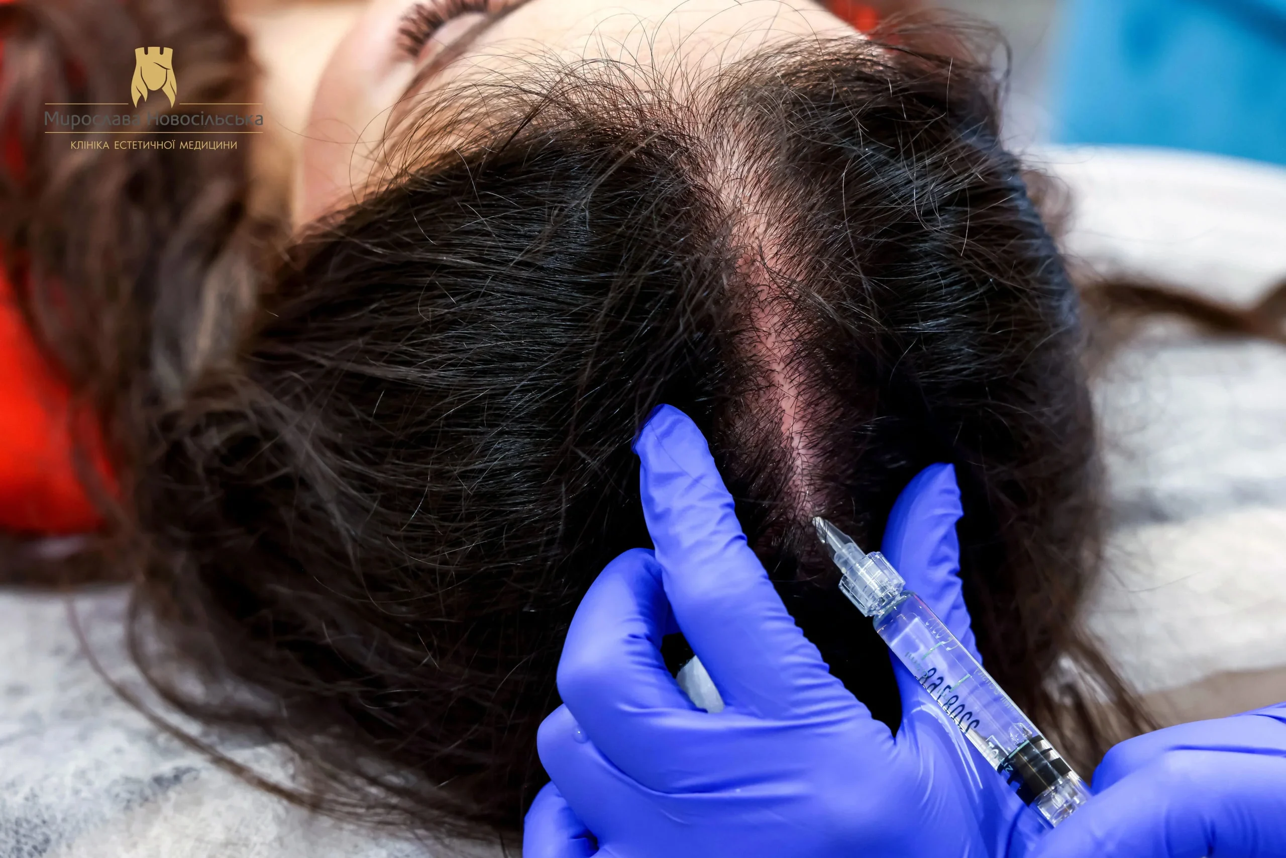 Scalp plasma therapy, photo 1