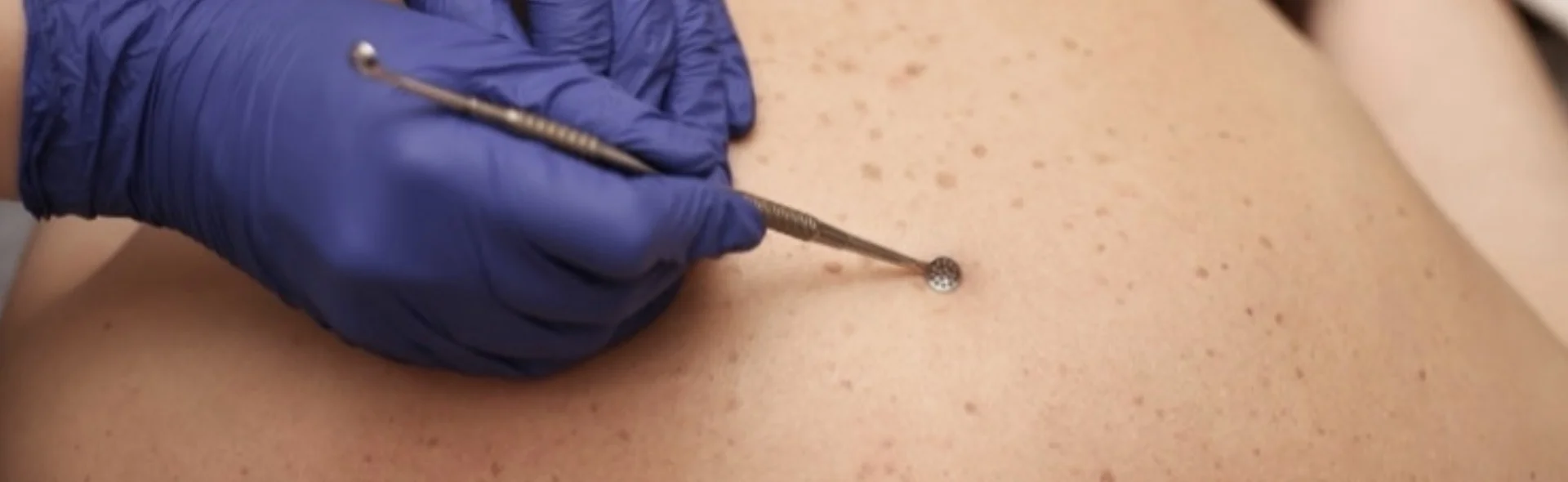 Back cleansing treatment, photo 1