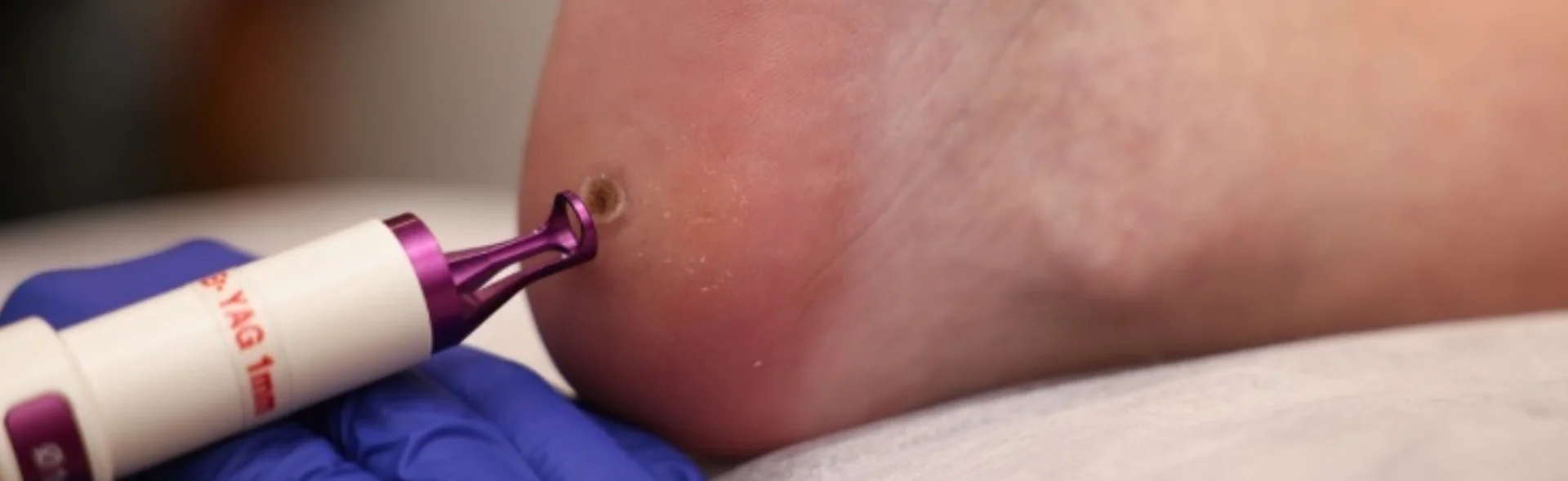 Removal of plantar warts, photo 1