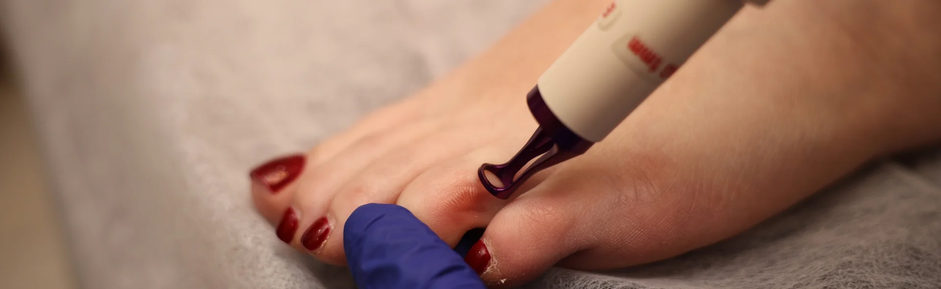 Removal of calluses, photo 1