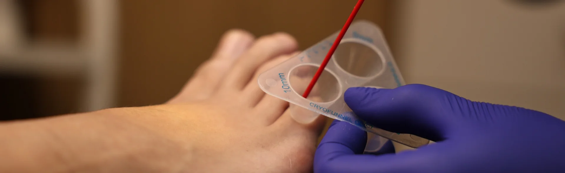 Callus removal with liquid nitrogen, photo 1