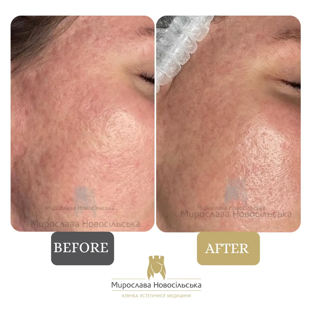 Microneedle RF lifting in Lviv