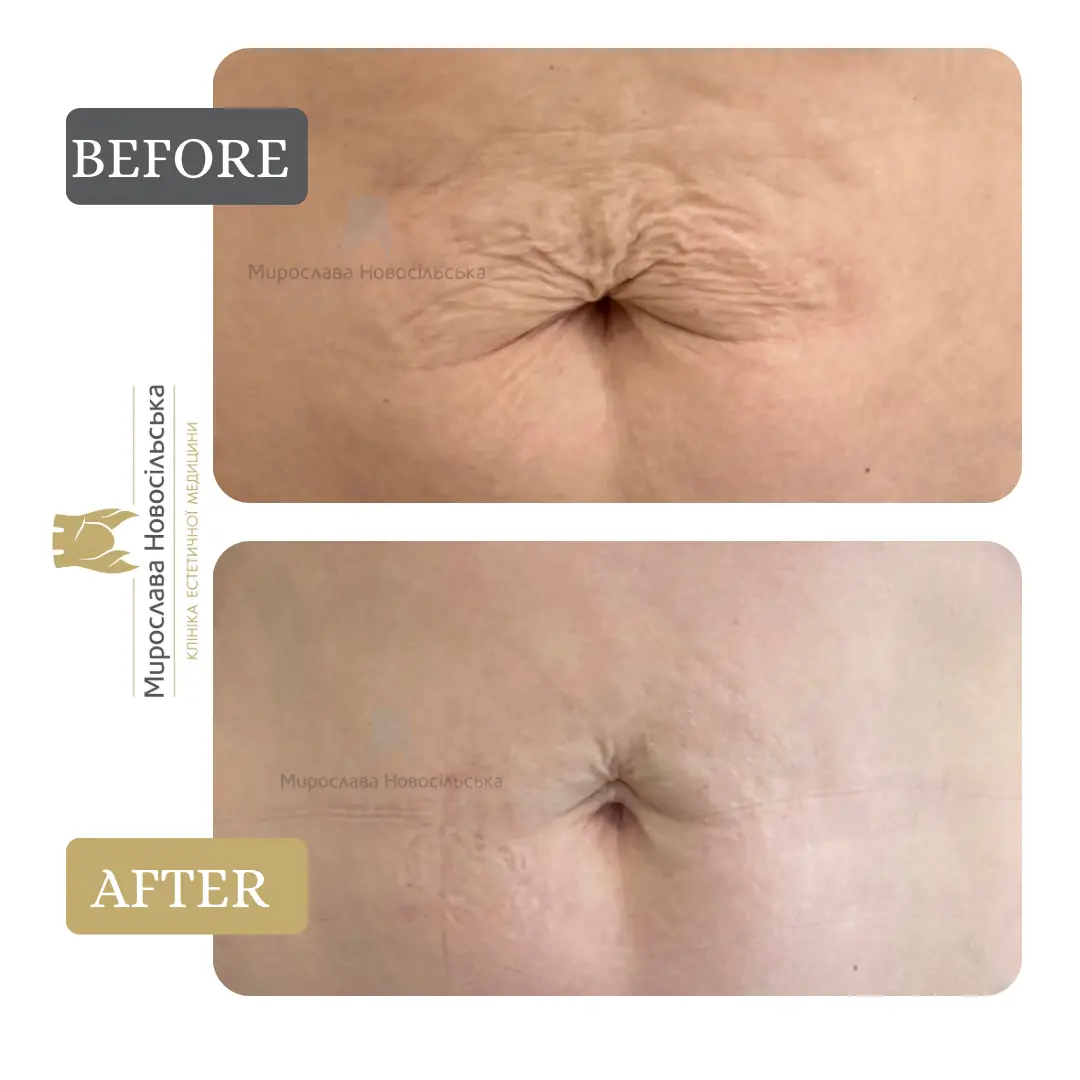 Microneedle RF lifting in Lviv