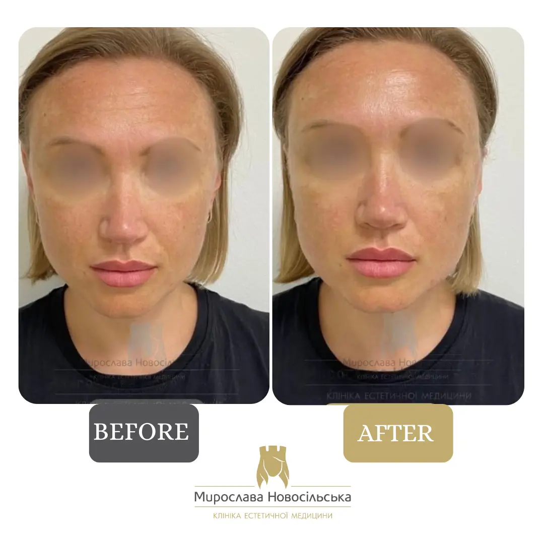Microneedle RF lifting in Lviv