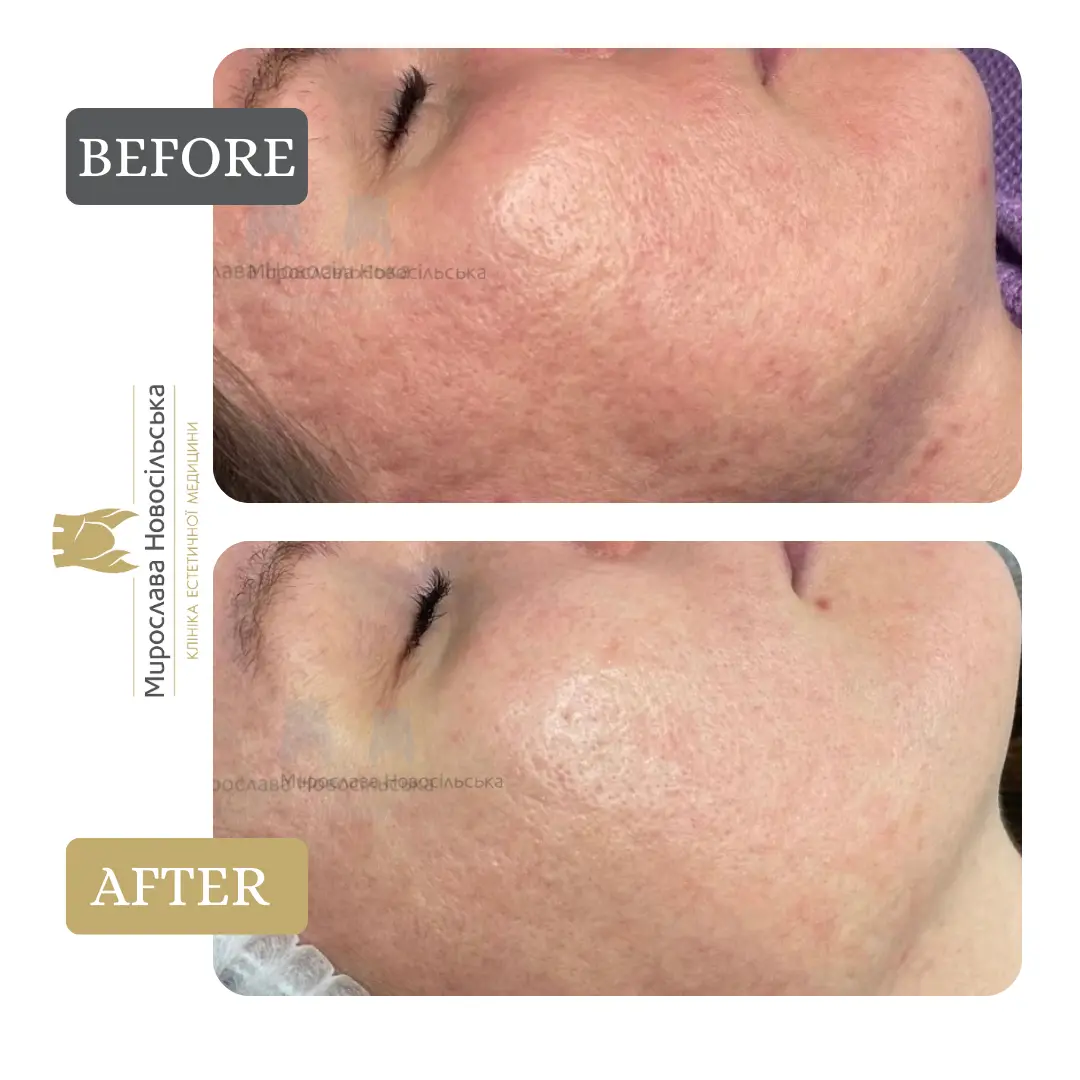 Microneedle RF lifting in Lviv