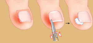 ingrown nail treatment