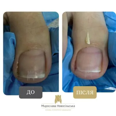 treatment of ingrown toenail in Lviv