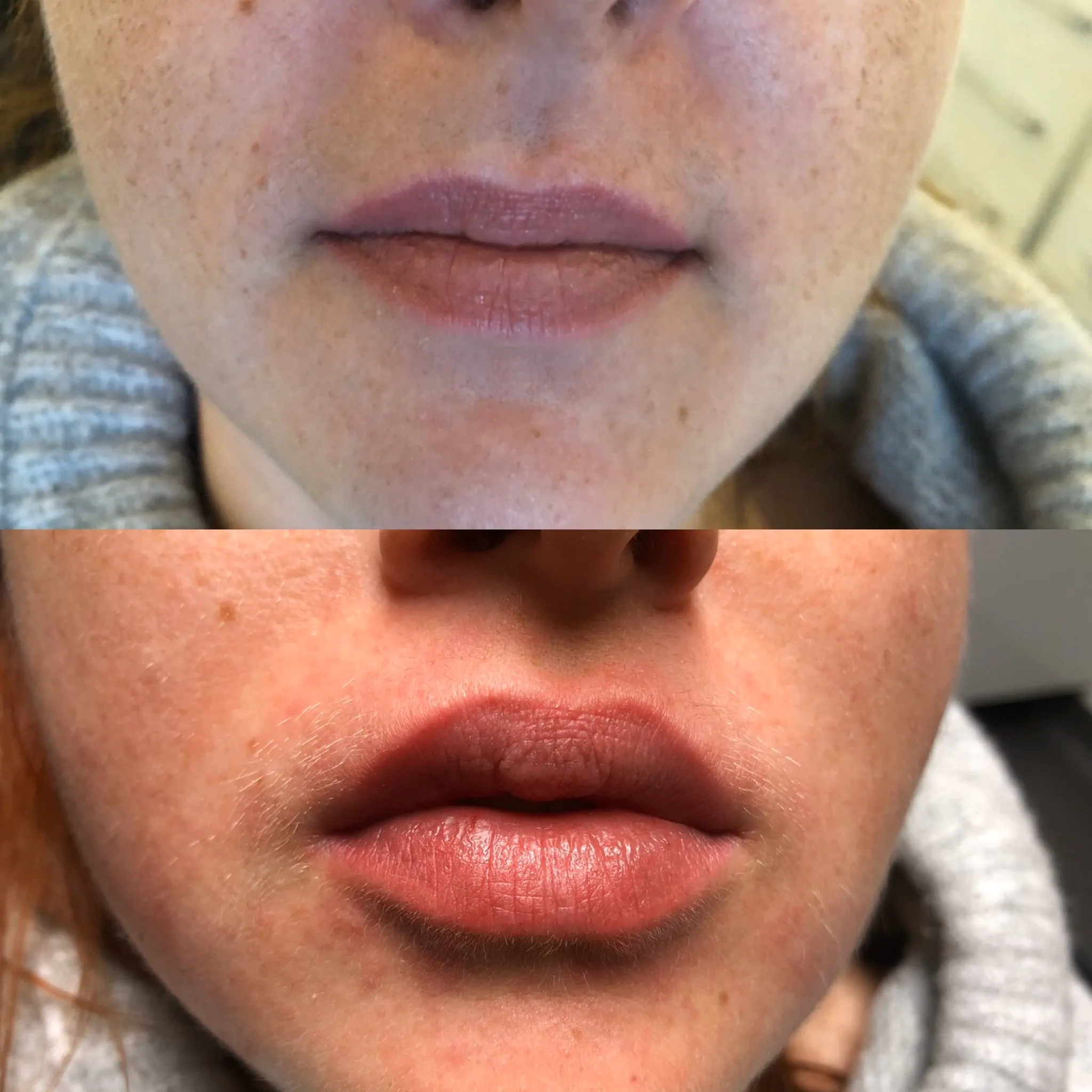 пересадка волосся у Львові