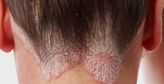себорейний дерматит шкіри голови