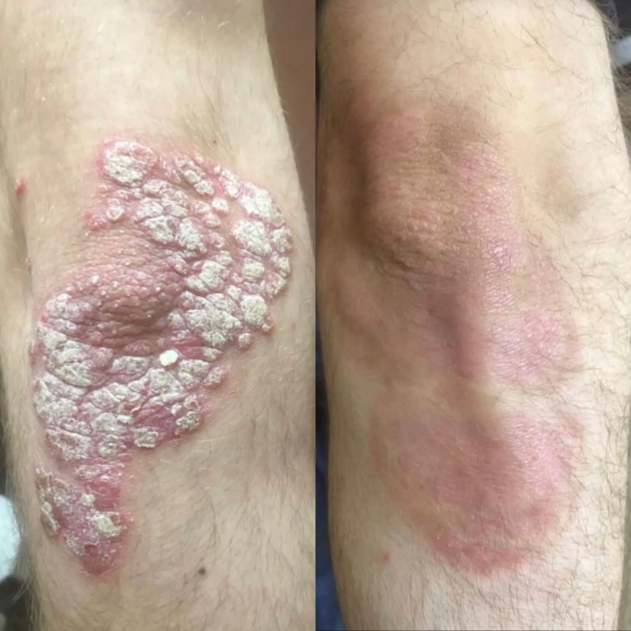 лікуавння псоріазу