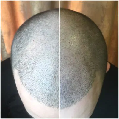 трихопігментація