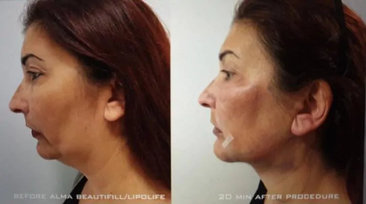 лазерний ліпофілинг у львові