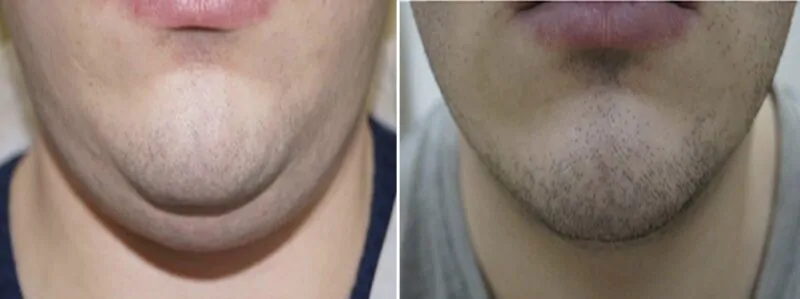 позбуватись другого підбобріддя