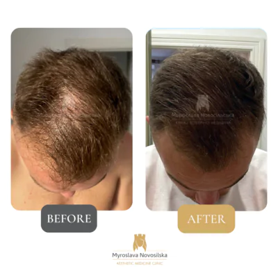 Result of Milta Head procedure