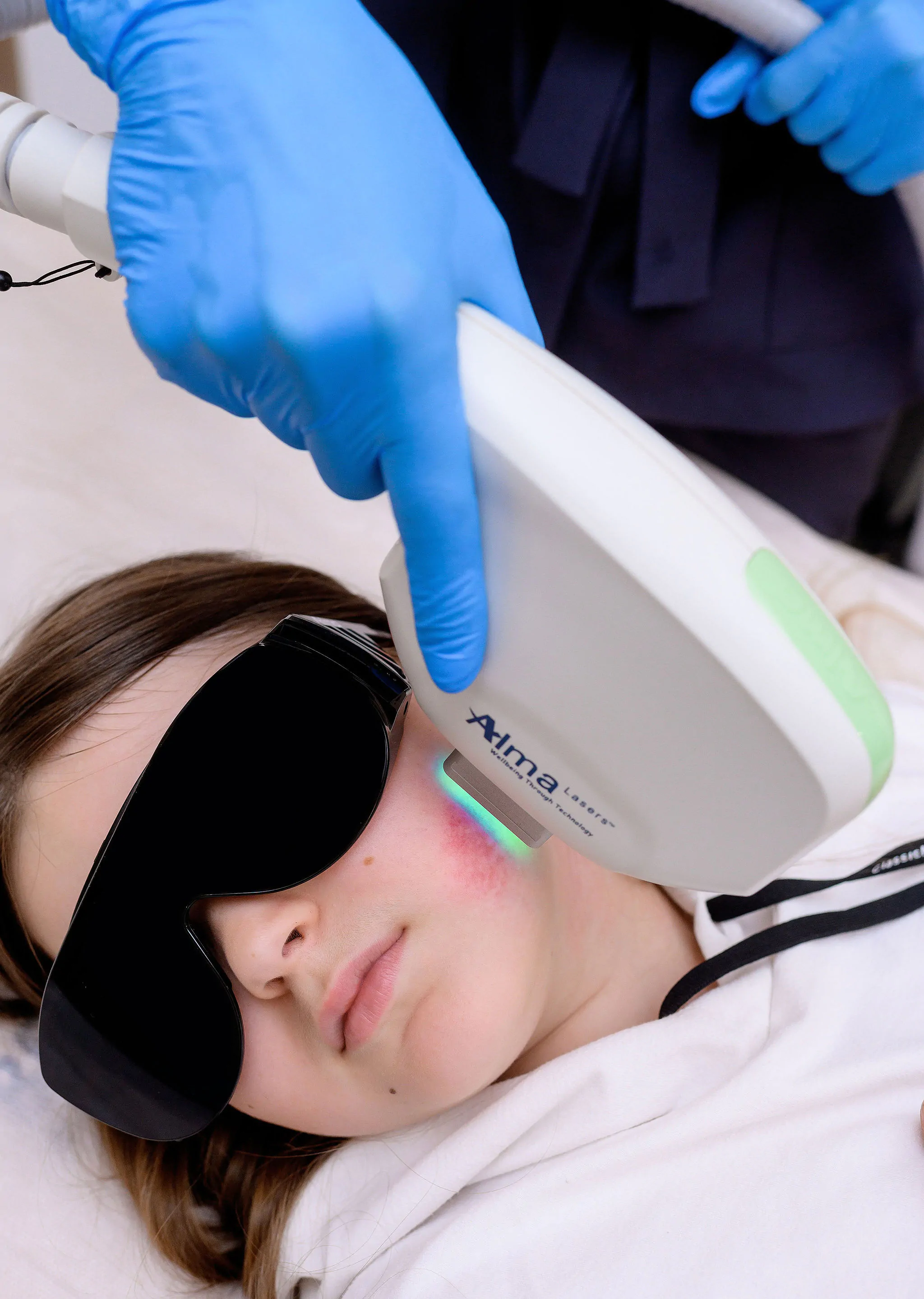 laser removal of blood vessels