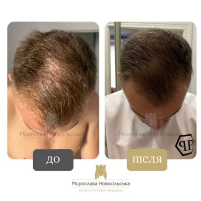апаратне збільшення густини волосся