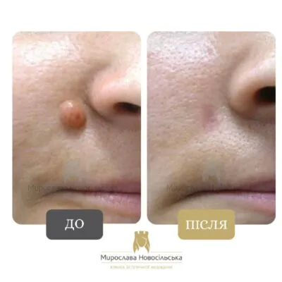 лазерне видалення родимки