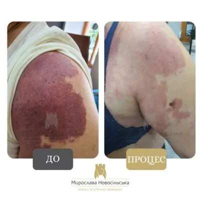 видалення гемангіоми