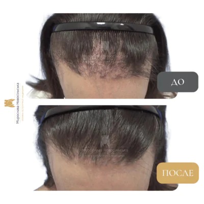 пересадка волос до и после №1